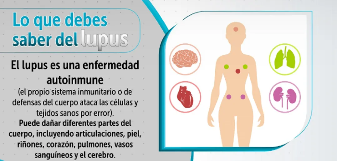 Lupus: no abandonar el tratamiento es crucial para lograr la remisión