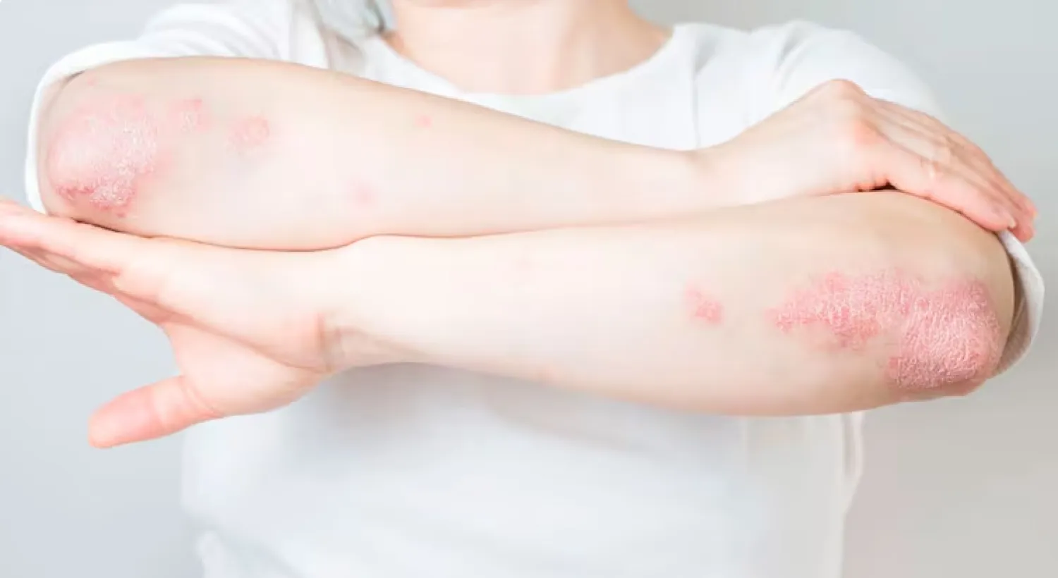 Día Mundial de la Psoriasis: especialistas instan a la detección temprana