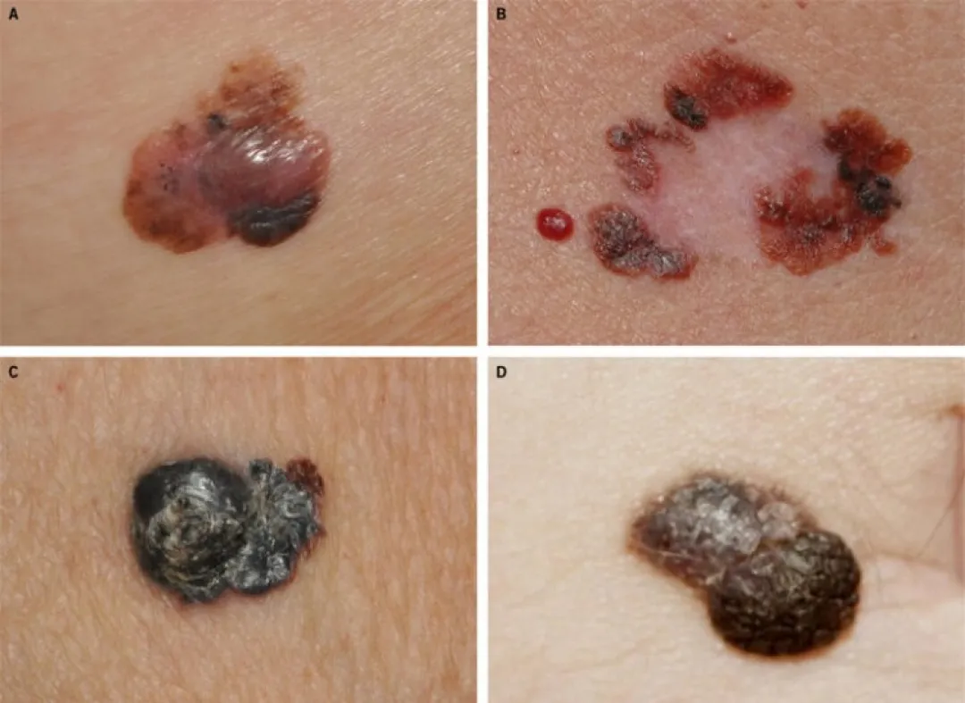 Los factores de riesgo del cáncer de piel, cómo prevenirlo y dónde acudir