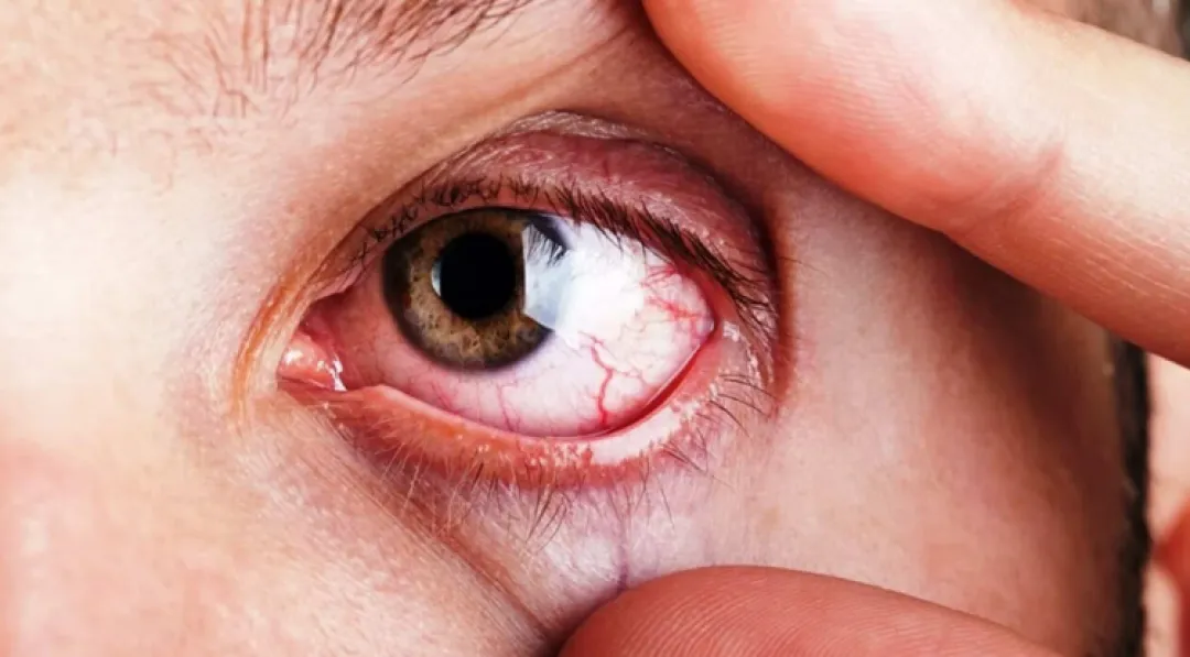 Campaña de prevención de glaucoma