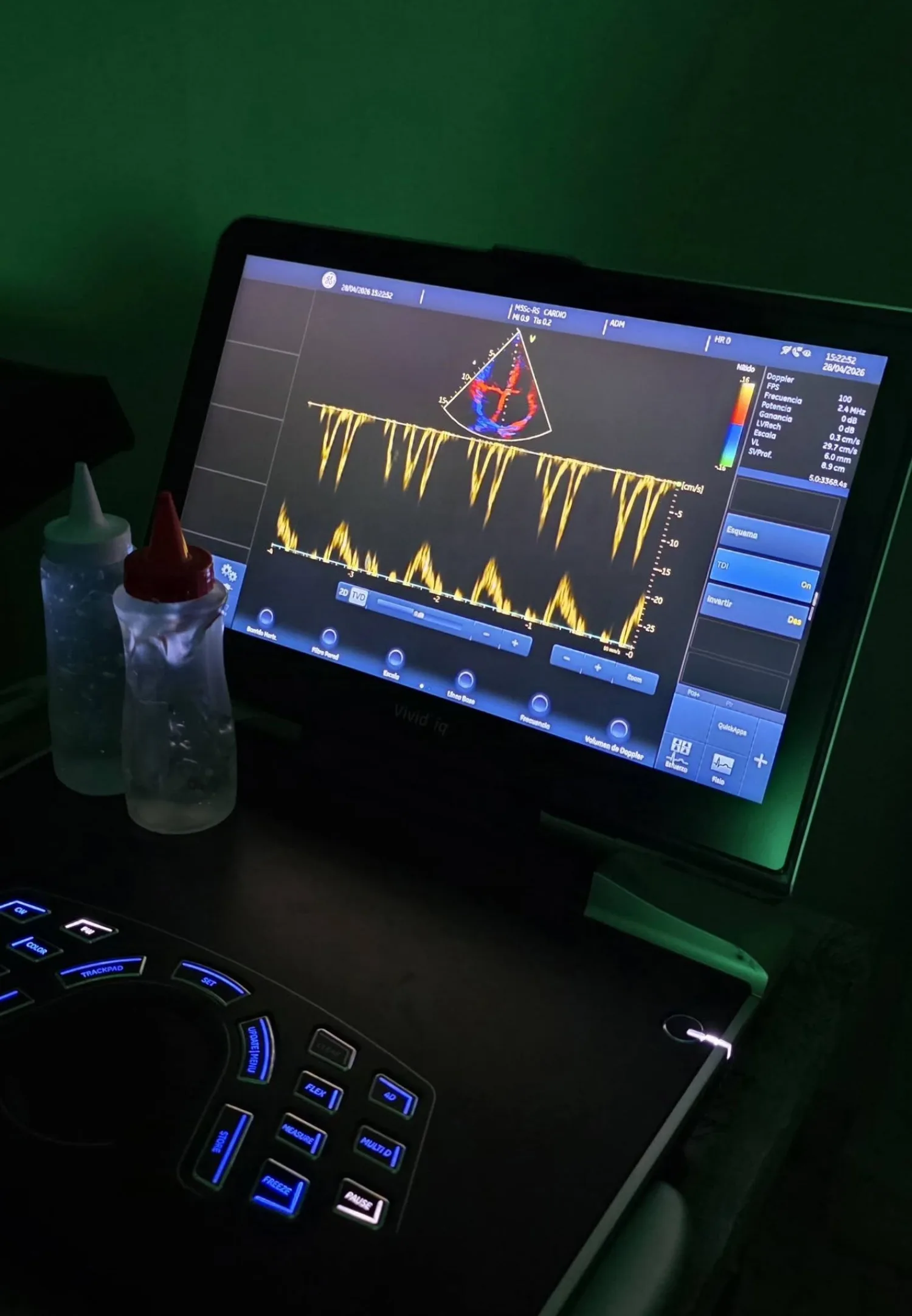 POR PRIMERA VEZ HABILITAN ESTUDIOS  DE  ECOCARDIOGRAMA EN IPS LOCAL