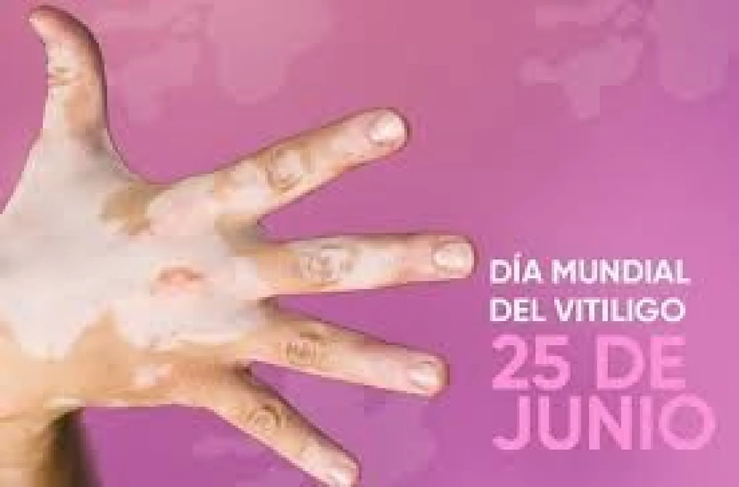 Día Mundial del Vitiligo se recuerda este jueves